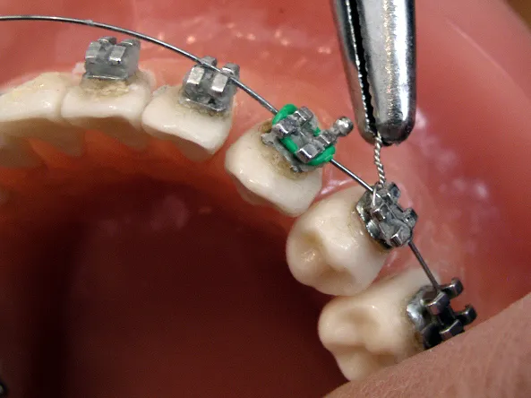 Self-Ligating Braces