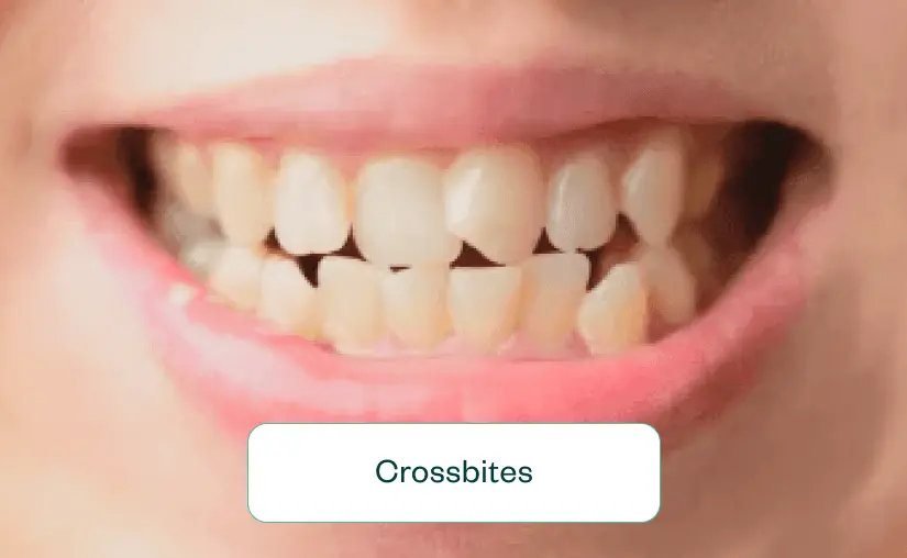 Crossbite