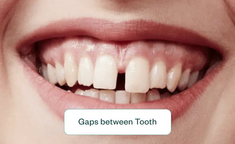 Gaps