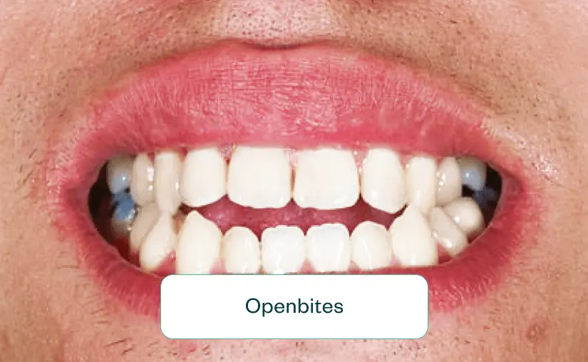 Openbite