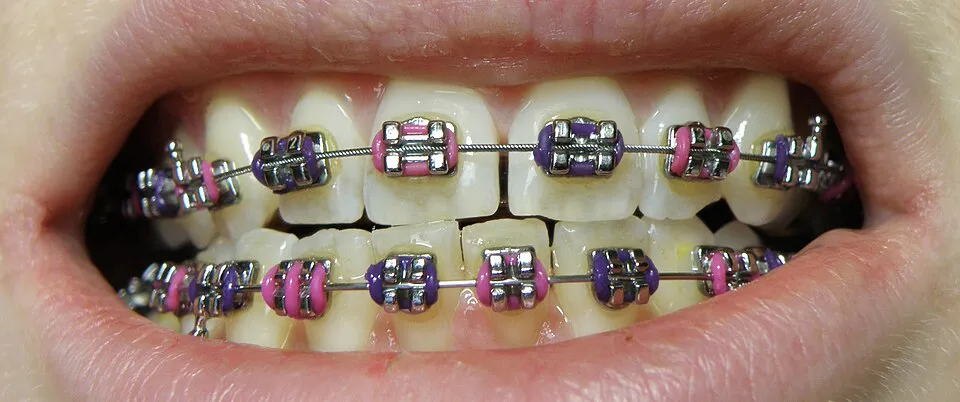 Traditional Metal Braces